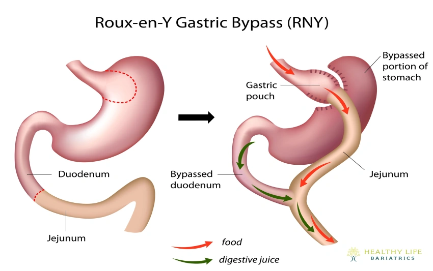 Types of Gastric Bypass Revision Procedures in Los Angeles