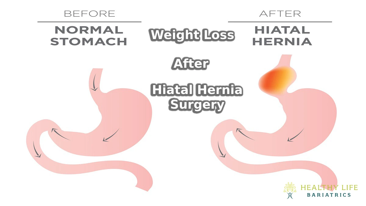 Weight Loss After Hiatal Hernia Surgery