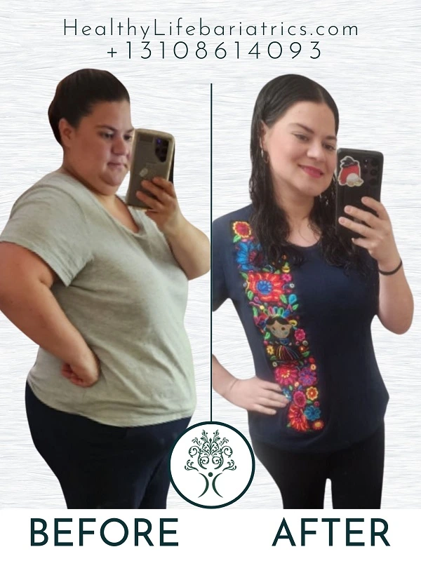 Weight Loss Surgery- Gastric Bypass Before and After LA, CA Weight Loss Surgery- Gastric Bypass Before and After LA, CA