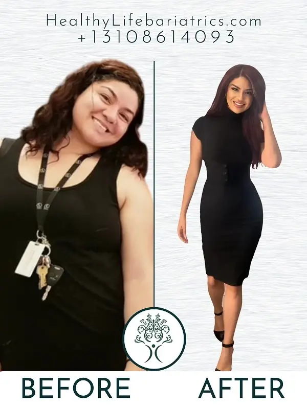 Weight Loss Surgery- Gastric Sleeve Before and After Los Angeles Weight Loss Surgery- Gastric Sleeve Before and After Los Angeles