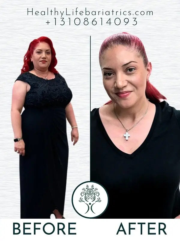 Weight Loss Surgery- Gastric Sleeve Results in Los Angeles Weight Loss Surgery- Gastric Sleeve Results in Los Angeles