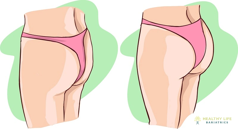 Benefits of a Butt Lift Post-Bariatric Surgery LA