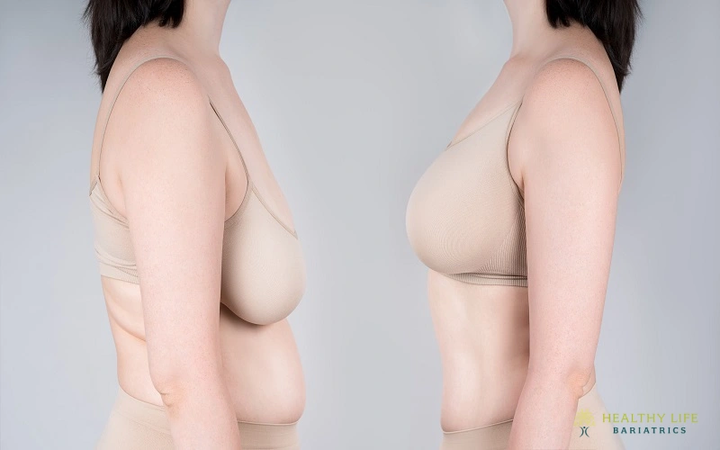 Breast Lift Recovery Timeline and Results Breast Lift Recovery Timeline and Results in Los Angeles