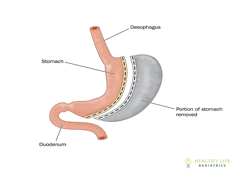 How SADI-S Works for Weight Loss