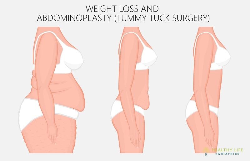 Tummy Tuck Surgery (Body Lift) in Los Angeles Tummy Tuck Surgery (Body Lift) in Los Angeles