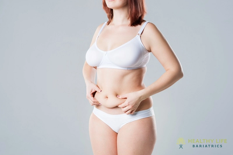 Who Is an Ideal Candidate for Belt Lipectomy Surgery Who Is an Ideal Candidate for Belt Lipectomy Surgery
