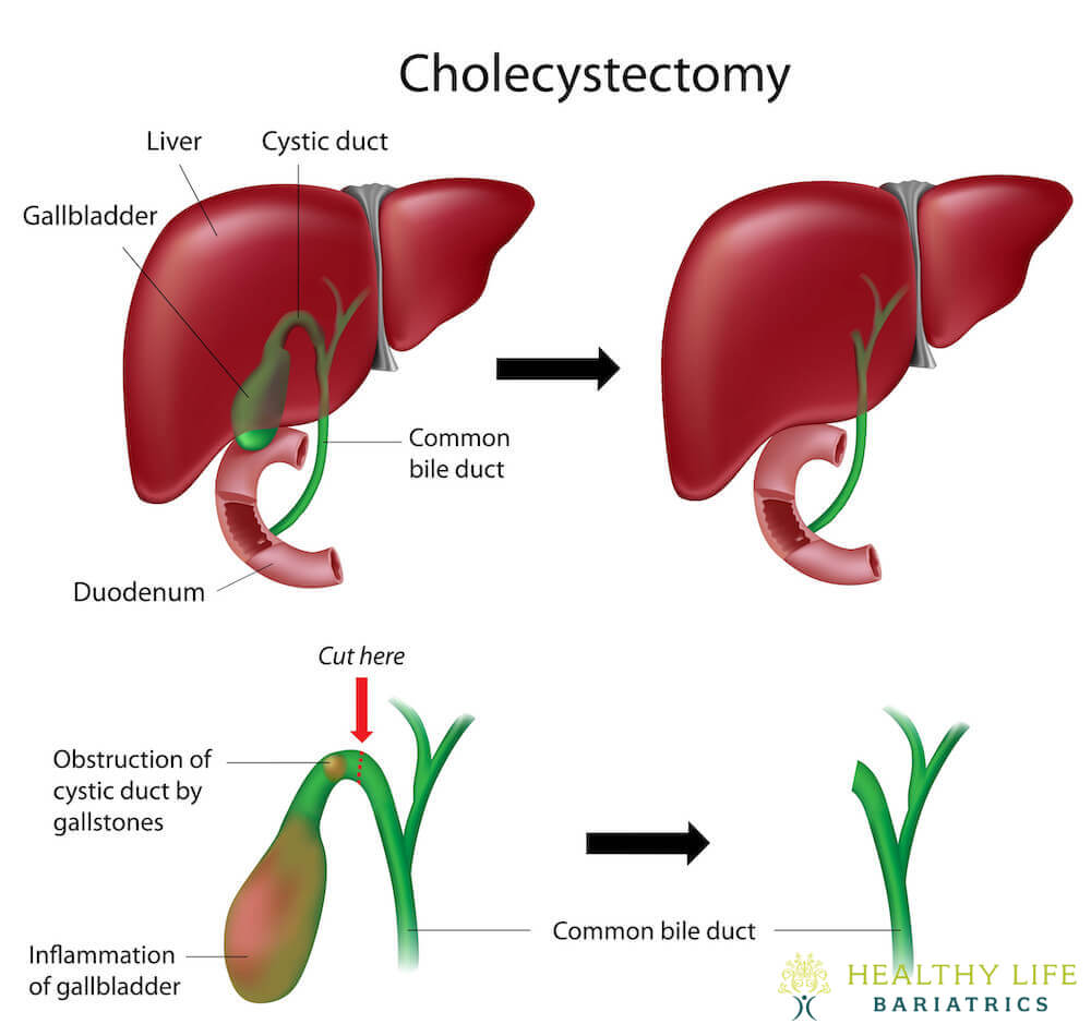 Acalculous Cholecystitis Los Angeles, CA Acalculous Cholecystitis Los Angeles, CA