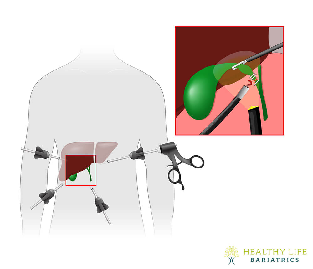 Acalculous Gallbladder Surgery in LA Acalculous Gallbladder Surgery in LA