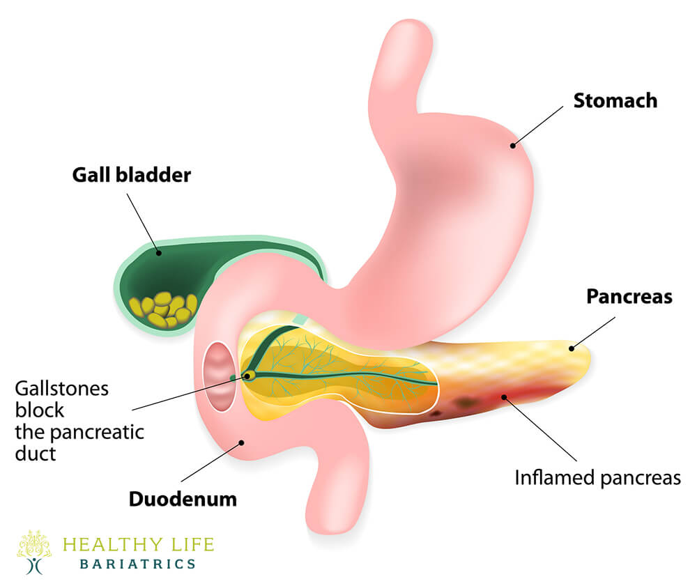 Acute Cholecystitis in Los Angeles, CA Acute Cholecystitis in Los Angeles, CA