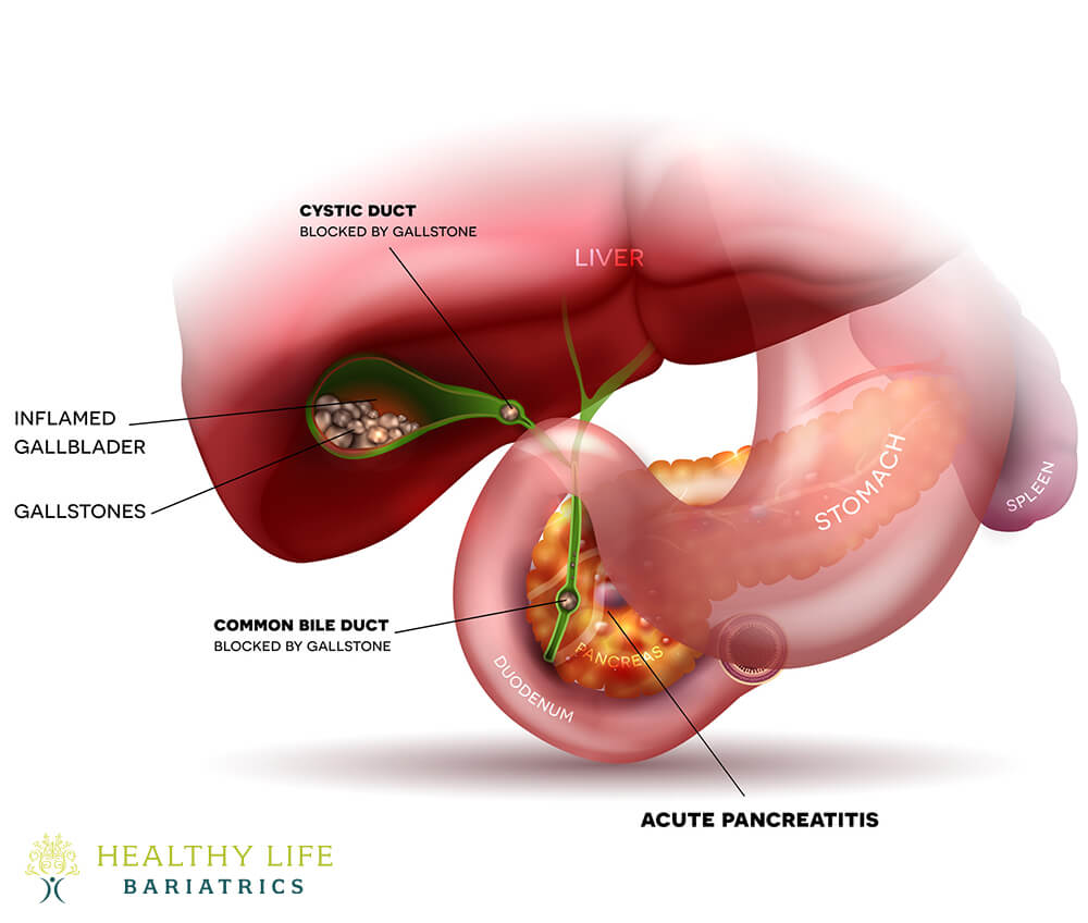 Acute Cholecystitis in Los Angeles CA Acute Cholecystitis in Los Angeles CA
