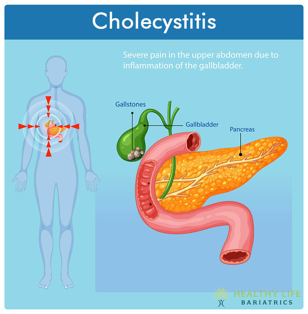 Acute Cholecystitis in Los Angeles Acute Cholecystitis in Los Angeles