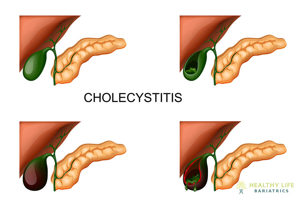 Acute Cholecystitis in Los Angeles CA Acute Cholecystitis in Los Angeles CA