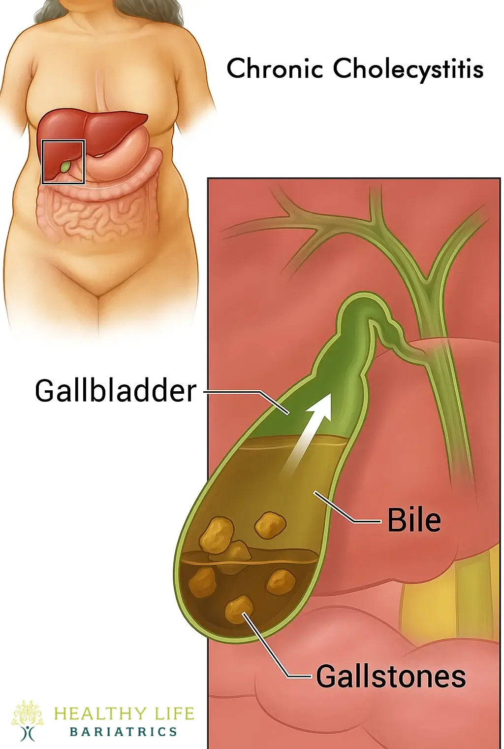Chronic Cholecystitis in Los Angeles, CA Chronic Cholecystitis in Los Angeles, CA