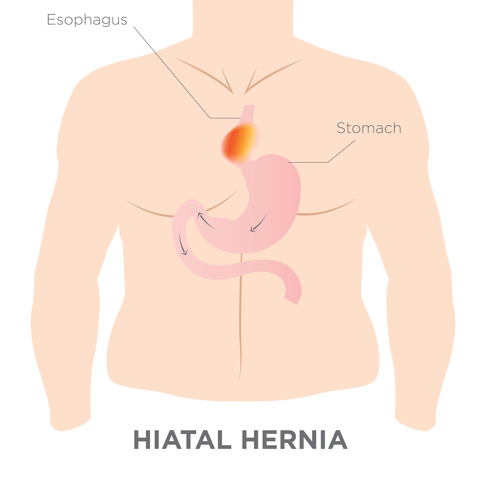Hiatal Hernia Surgery Los Angeles, CA