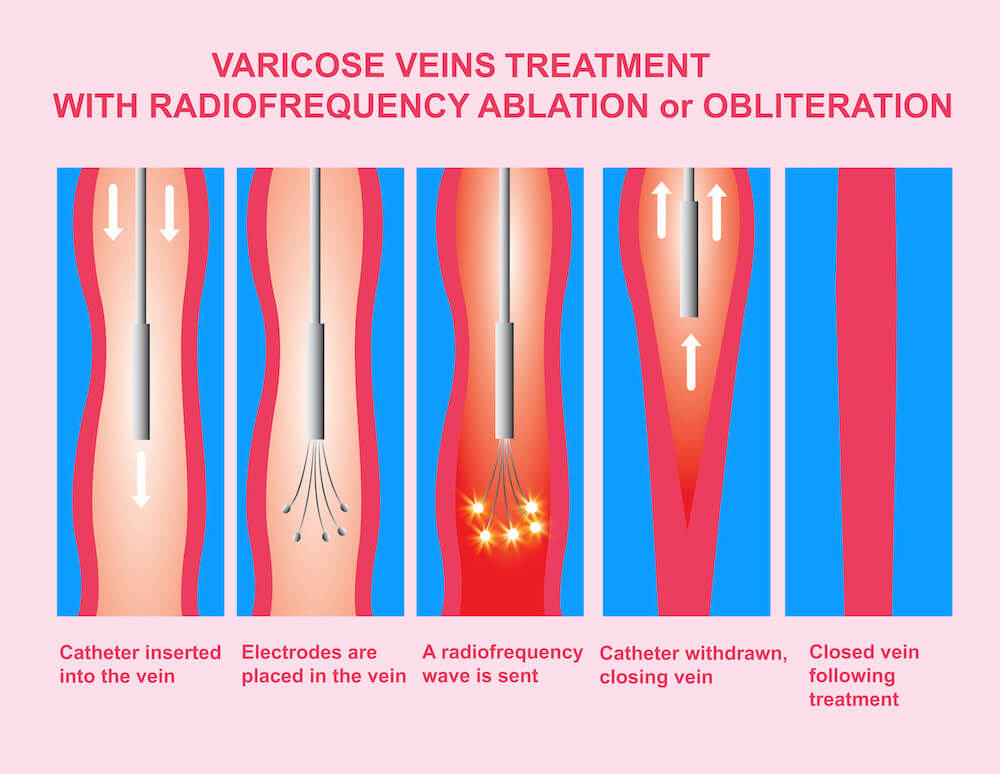 Radiofrequency Ablation in Los Angeles, CA