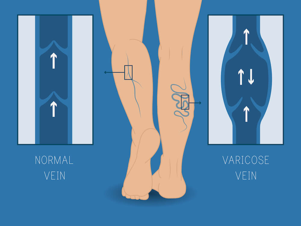 Sclerotherapy in LA