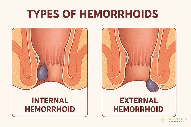 Types of Hemorrhoids