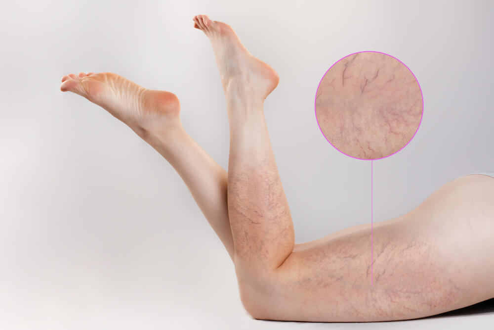 Varicose Veins in Los Angeles, CA