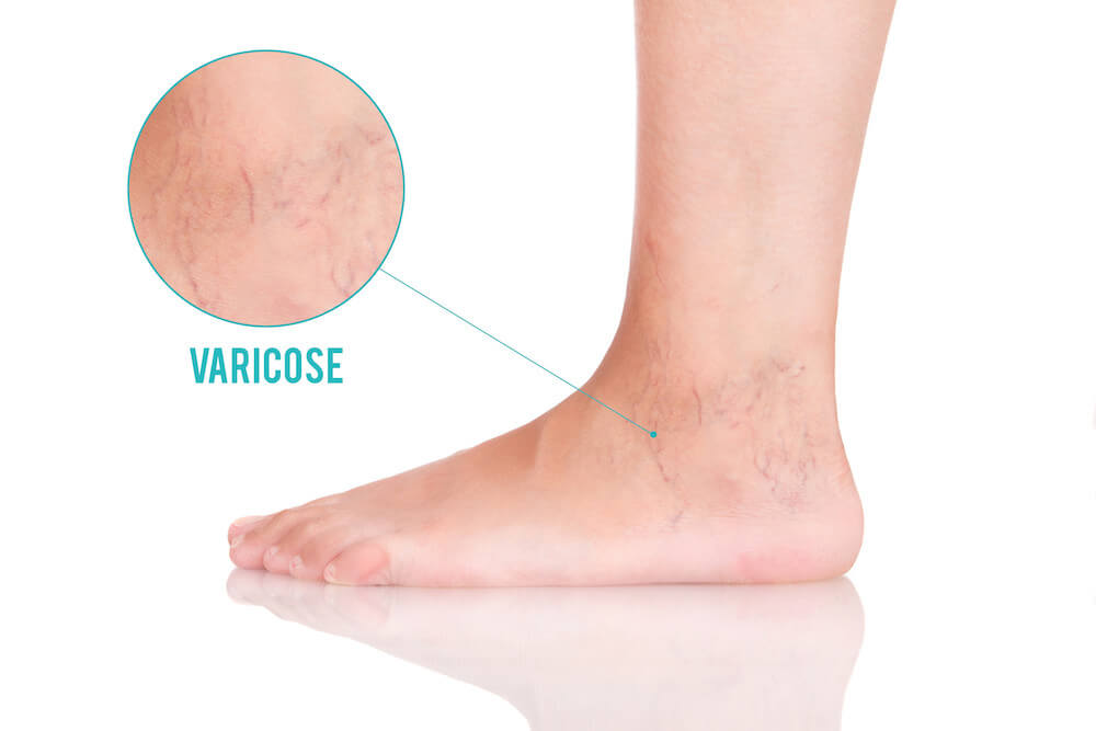 Varicose Veins in Los Angeles CA