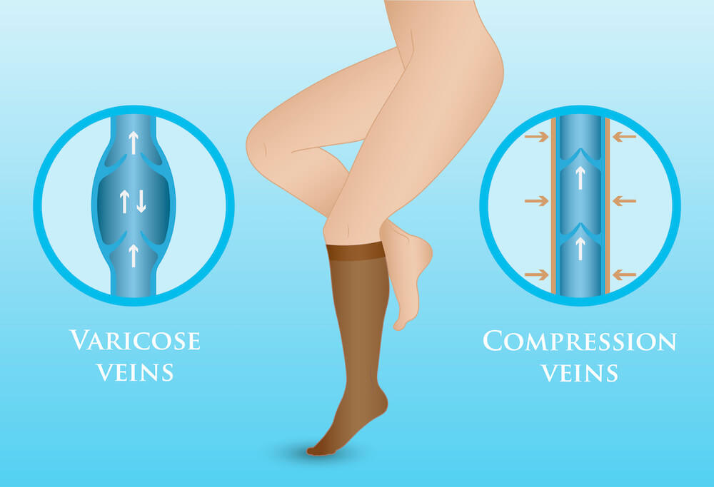 Compression Socks for Varicose Veins- LA