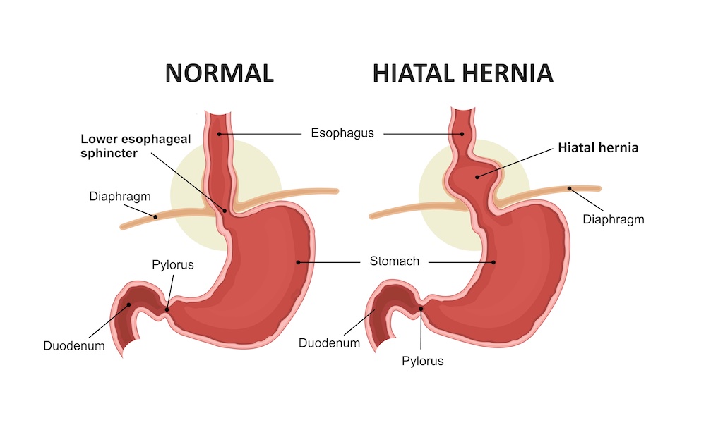 Hiatal Hernia Surgery in Los Angeles CA