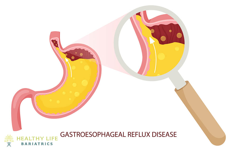 GERD Surgery in Los Angeles