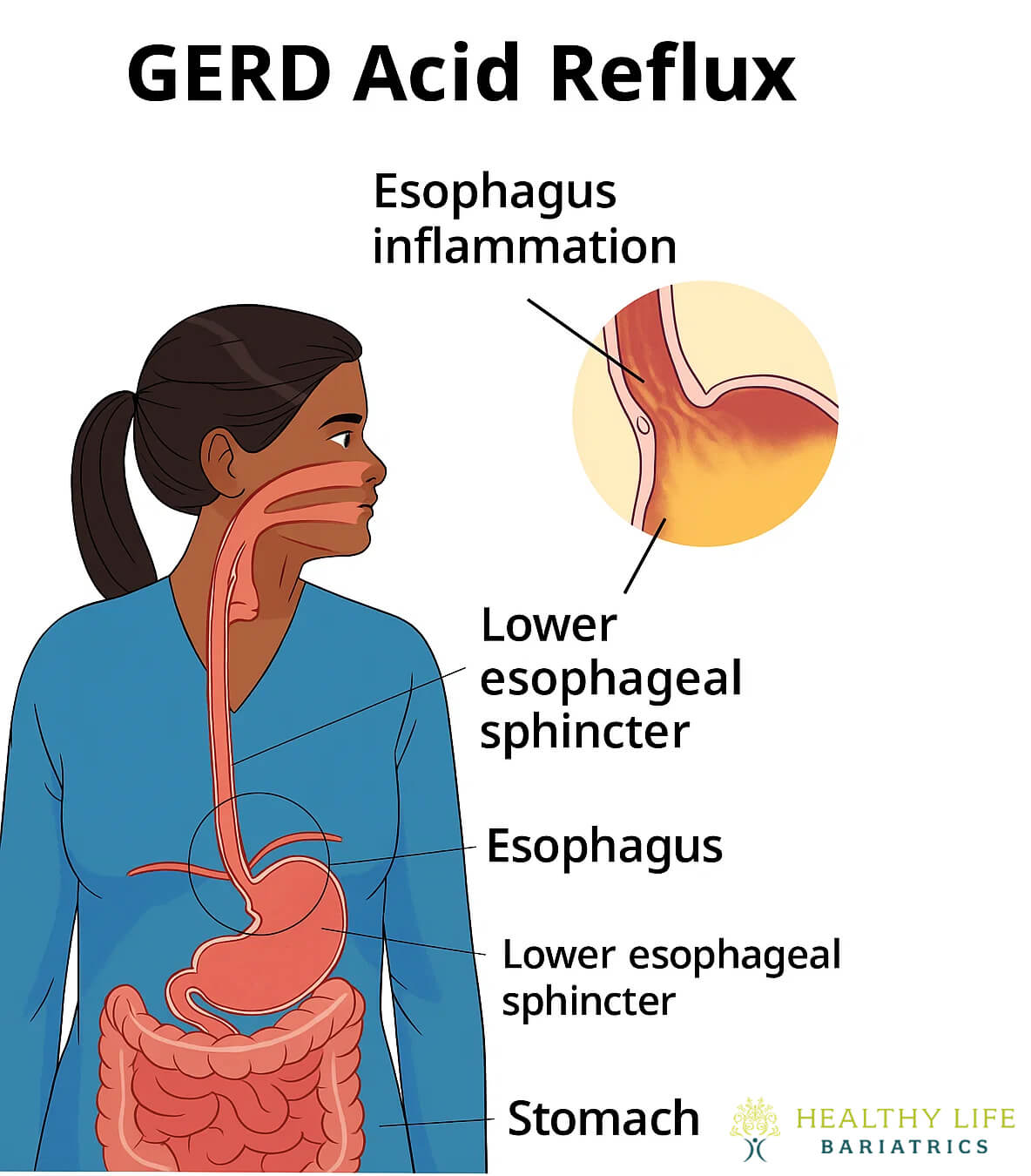 GERD Surgery in Los Angeles, CA