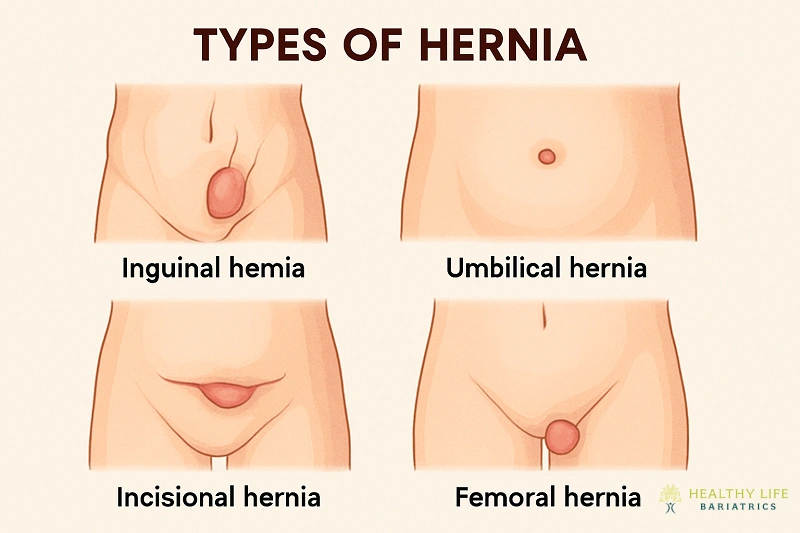 Hernia Types Explanation by Dr. Moein in Los Angeles