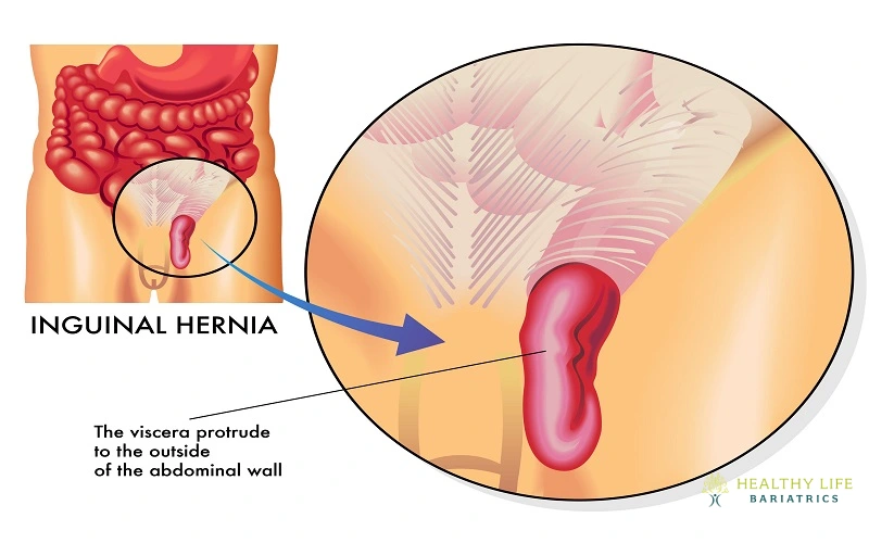 Inguinal Hernia Surgery in Los Angeles, CA