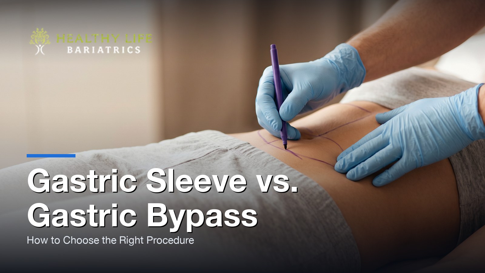 Gastric Sleeve vs. Gastric Bypass: How to Choose the Right Procedure